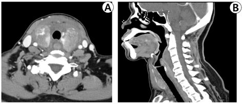 A Case of Diffuse Thyroid Hematoma after Ultrasound-Guided Fine Needle ...