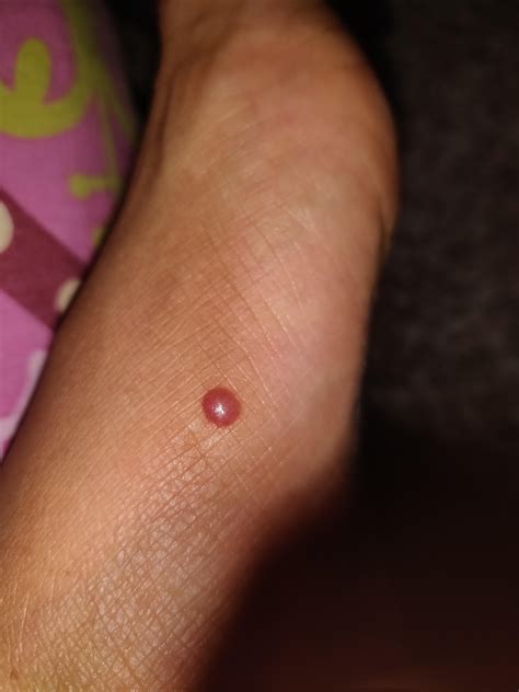What kind of bug bite? Bites on legs turning to blisters. Bites on hands with swelling and after ...
