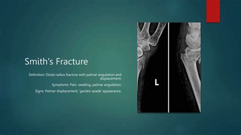 Colles' and Smith's fractures are common distal radius fractures with distinct characteristics ...