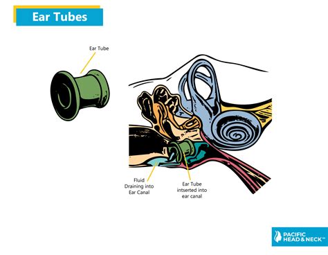 Ear Tubes - Pacific Head & Neck