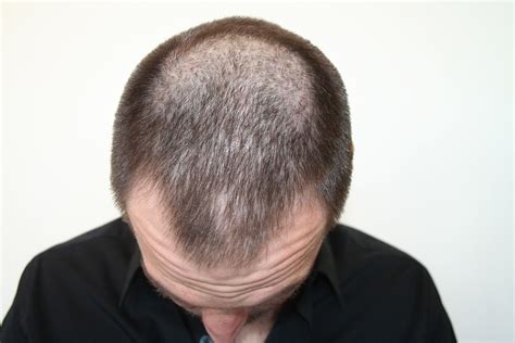 On Stage Hair Design: Nioxin/Rogaine: Does it Really Work?