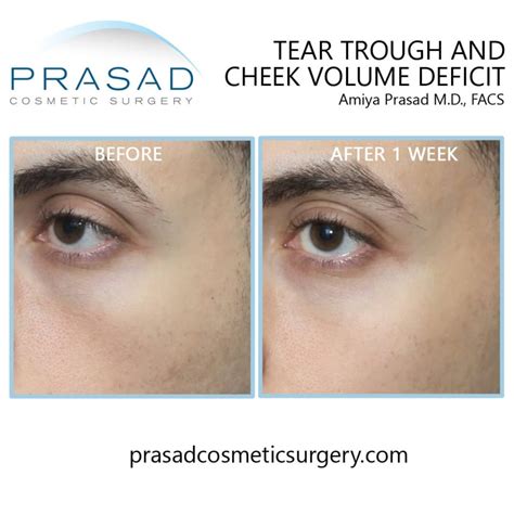 Under Eye Fat Transfer: Possible Complications & Safer Alternative