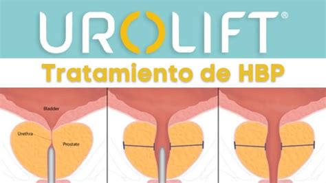Image result for Urolift Recovery Process