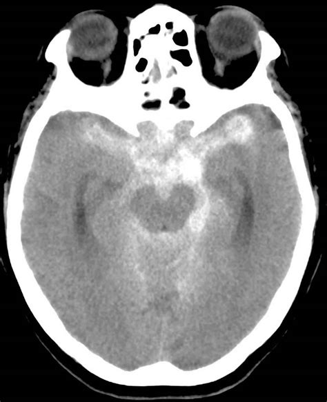 Brain hemorrhage causes, types, symptoms, diagnosis & treatment