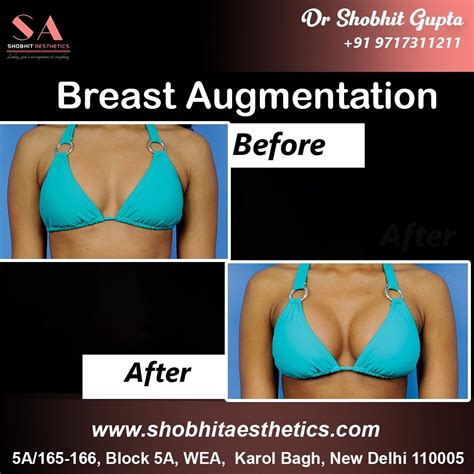 Fat Transfer Breast Augmentation Before After Cosmetic Fat Transfer