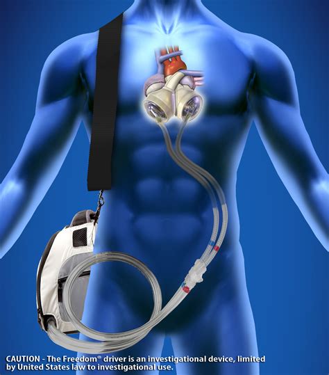 Total Artificial Heart