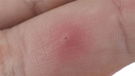 Image result for Infected Splinter Removal