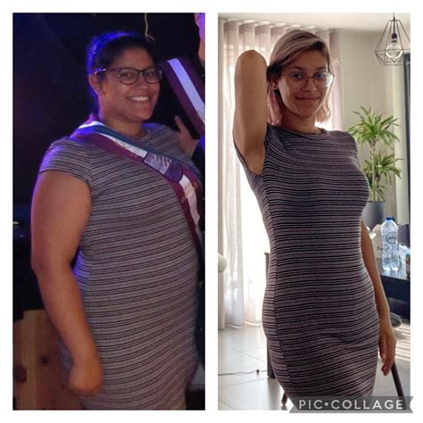 It’s my surgversary! Exactly one year ago I had my sleeve done by dr ...