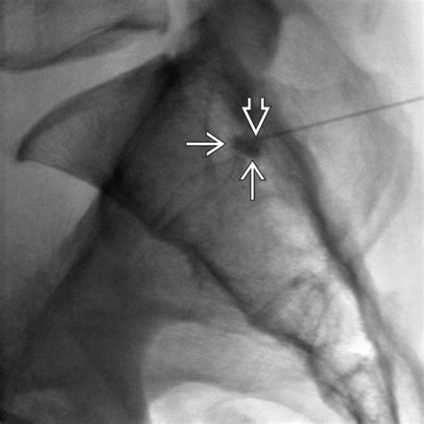 Image result for Nerve Root Block Triangle