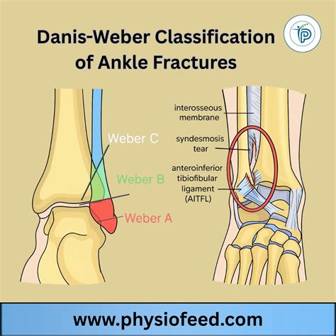 Danis-Weber Classification of Ankle Fractures