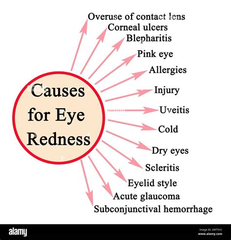 Eye hemorrhage Cut Out Stock Images & Pictures - Alamy