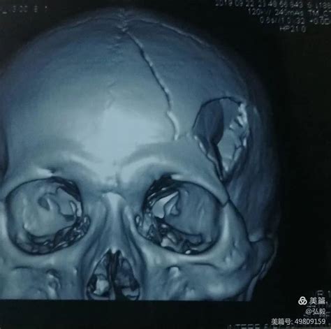 颅骨骨折的影像征象_医学界-助力医生临床决策和职业成长