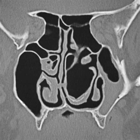 Functional Turbinoplasty - Clinical Tree