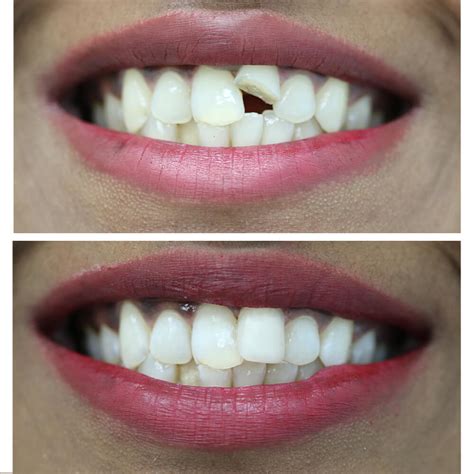 Image result for Broken Tooth