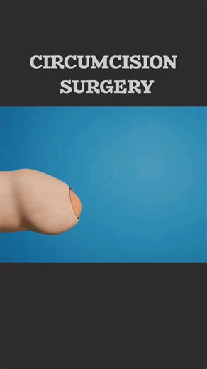 How ZSR Circumcission Surgery Eskin. Performed? (3D Animation) #circumcission #circumcision #circumcissionsurvivor #circumcissionsurgery #circumcissionsurvivor