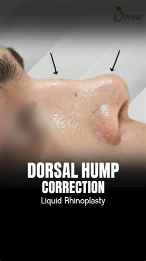 Liquid Rhinoplasty for Dorsal Hump | Non-Surgical Nose Job Before & After