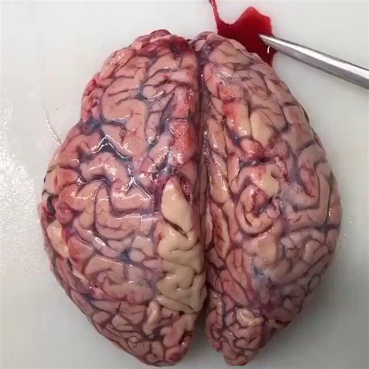 RT @docakx: You can clearly make out the cause of this person's death by watching this autopsy video.