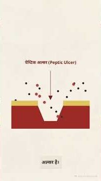 Peptic Ulcer / Peptic Ulcer Disease