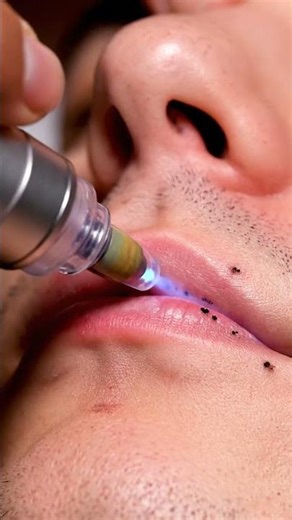 Viral Pimple Popping Compilation (USA) – Satisfying Acne Removal! #satisfying #blackheadcaique