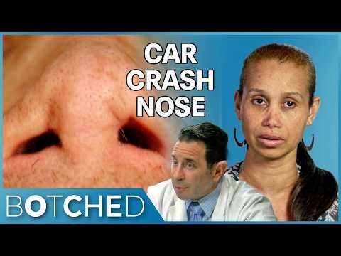 Michelle Survived A Car Crash That DESTROYED Her Nose | Botched | E!
