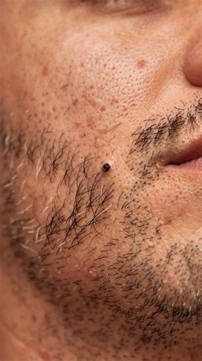 The Blackhead Hiding in His Ear Canal#BlackheadRemoval #earcanal #Dermatology#Skincare #PoreCleaning #darkspotremoval