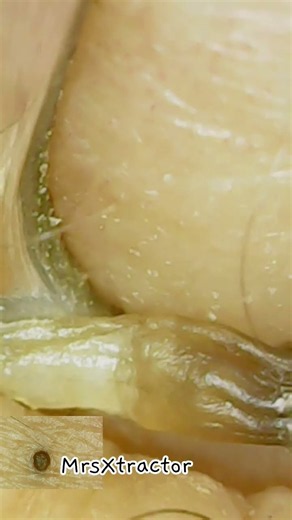 ONE HUGE BLACKHEAD #blackheads #pimple #satisfying #satisfyingvideos