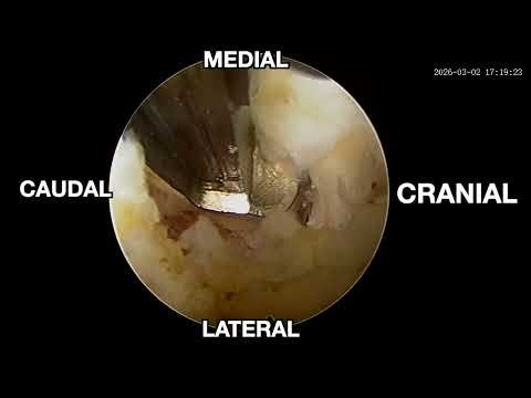 L4-L5 PIVD with CANAL STENOSIS| Full Endoscopic Discectomy Decompression|Dr.Mahesha.K|Dr.Bhanu Teja 