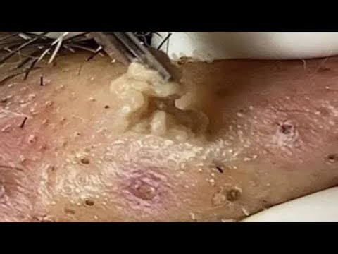 Deep blackhead Removal 2026, acne removal spa, big pimple 2026, #acne #pimple #cyst