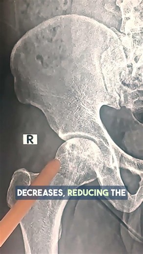 In AVN-Can Other Hip Still Be Saved? #drpankajwalecha #hiprehab
