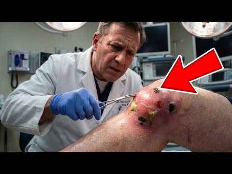 Man Thought Knee Effusion—Until Doctors See What’s Inside, And Everyone Is Left Horrified!