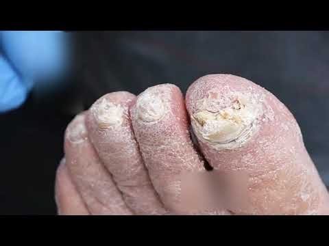 Thick Toenail Trimming