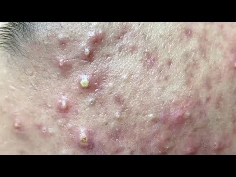 Deep blackhead Removal 2026, acne removal spa, big pimple 2026, #acne #pimple #cyst