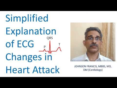 Simplified Explanation of ECG Changes in Heart Attack