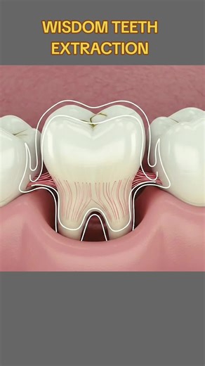 Wisdom Teeth Extraction (3D Animation) 28.3K #wisdomteethremoval #wisdomteethextraction #wisdomteethextractions #teethremoval #wisdomteethsurgery #toothextraction #toothextractionsurgery #dentalextractions #medical3danimation #3dmedicalanimation