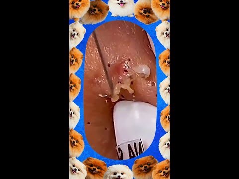 Blackheads Removal | Acne Treatment and Very Satisfying Satisfying Pimple pop #blackheads