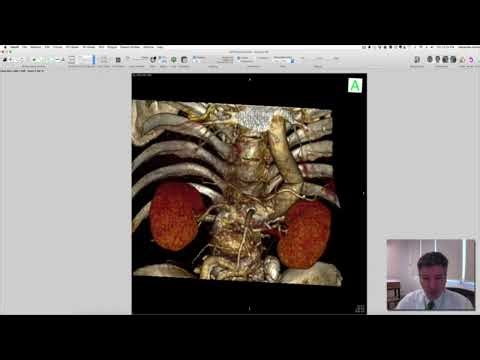 Cmd-K no OsiriX: criando imagens-chave para imprimir laudo (PDF)