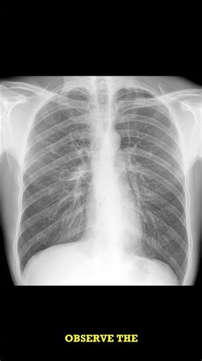 Chronic Bronchitis Chest X-ray: Deformed Markings