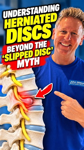 Understanding Herniated Discs: Beyond the “Slipped Disc” Myth