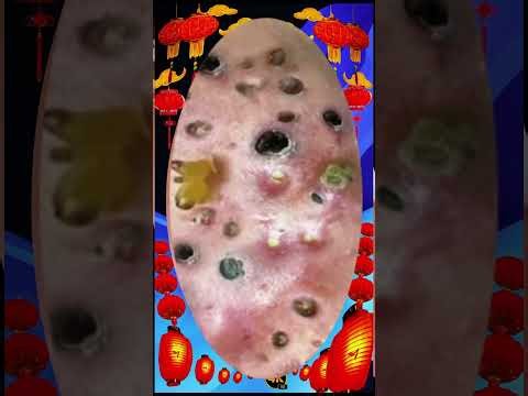 Blackheads Removal #461 | Acne Treatment and Very Satisfying Satisfying Pimple pop #blackheads