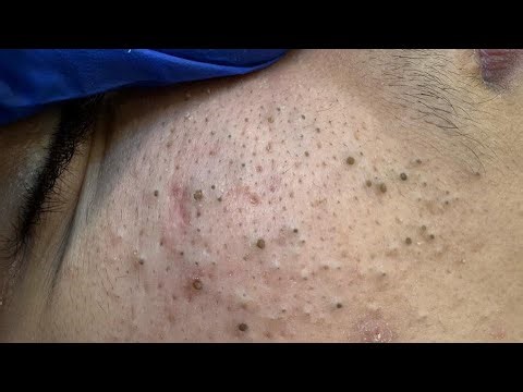Satisfying Blackheads Removal — Deep Facial Cleansing and Skincare Routine
