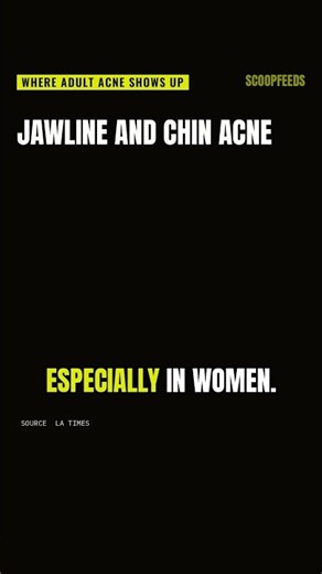 Adult acne can come back, and it can hurt your confidence