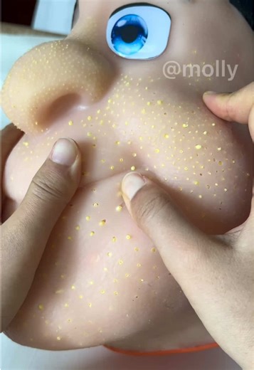 Satisfying Pimple Popping ASMR Experience