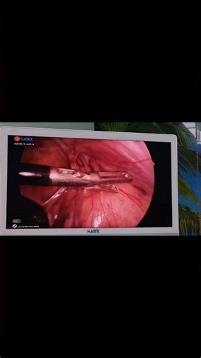 Lap inguinal hernia repair