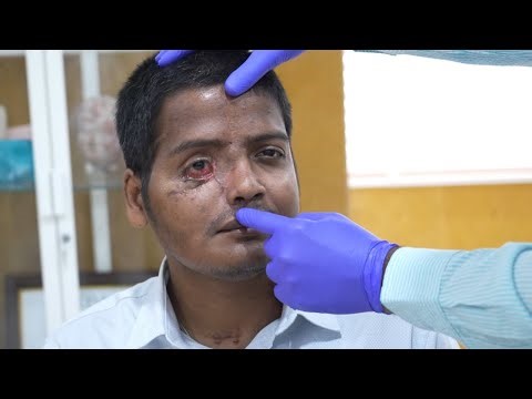 Severe Orbital Fracture Repaired After Two-Wheeler Accident