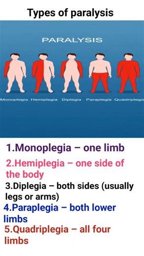 Types of Paralysis Explained | Monoplegia to Quadriplegia (Nursing Notes)