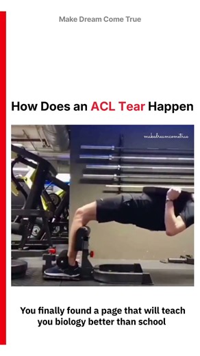 🦵 How Does an 🦴 ACL Tear Happen 🧑🏻‍⚕️ | MDCT