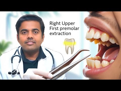 Live Tooth Extraction | Extraction of upper right premolar during orthodontic treatment