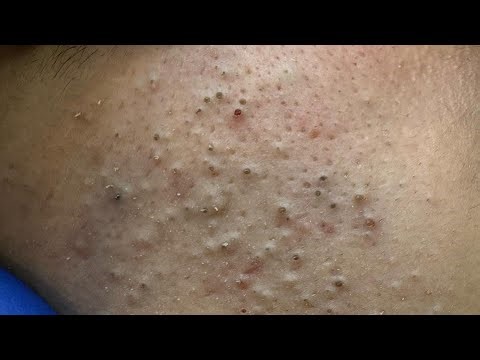 Satisfying Blackhead Removals & Deep Cleansing Techniques | ASMR