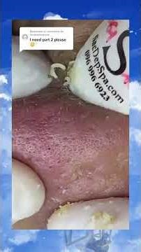 Insane Pimple Popping!!!
