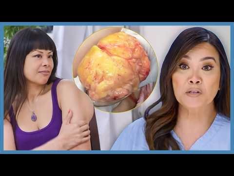 Woman’s Grapefruit-Sized Arm Lump Is Finally Removed | Dr Pimple Popper